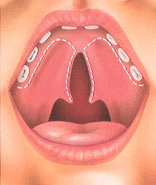 Волчья пасть расщелина твердого неба