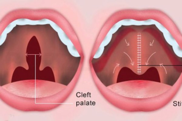 Субмукозная расщелина губы