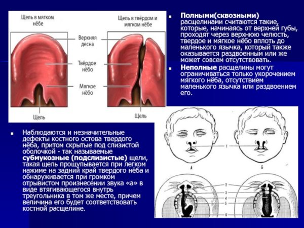 Субмукозная расщелина губы
