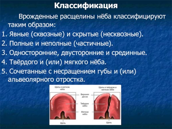 Расщелина неба классификация