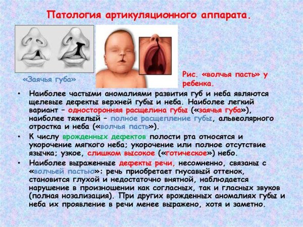 Врожденная расщелина неба классификация