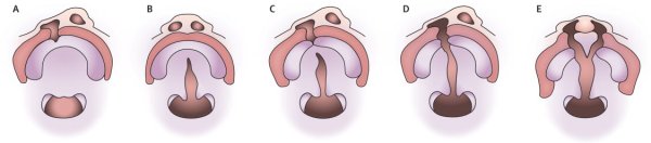 Волчья пасть расщепление неба