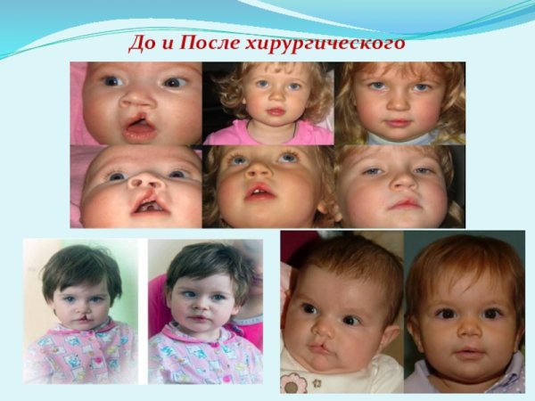 Классификация расщелин альвеолярного отростка