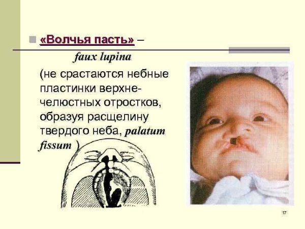 Врожденная субмукозная расщелина мягкого неба