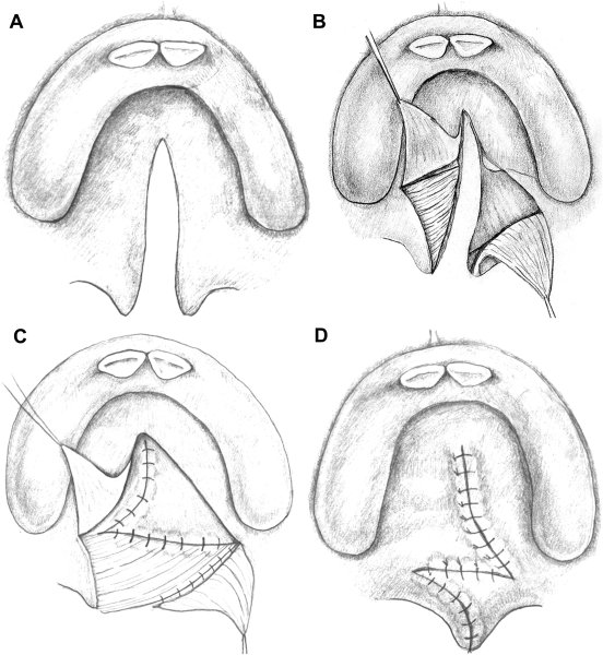 Уранопластика по Лангенбеку