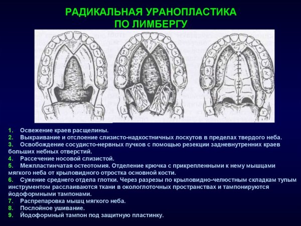 Классификация расщелин твердого неба