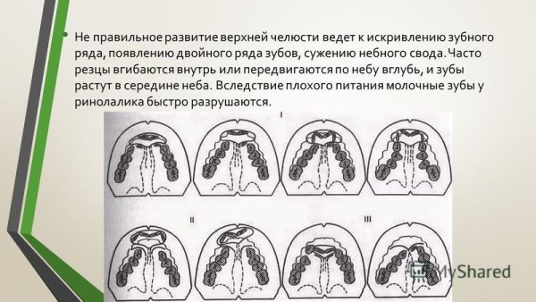 Синдром Патау заячья губа