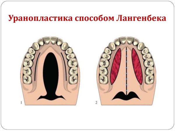 Врожденная расщелина твердого неба