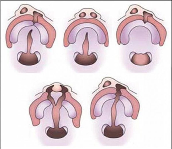 Логопедический массаж для детей при ринолалии