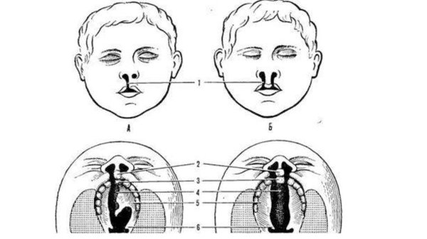 Врожденные расщелины верхней губы и неба