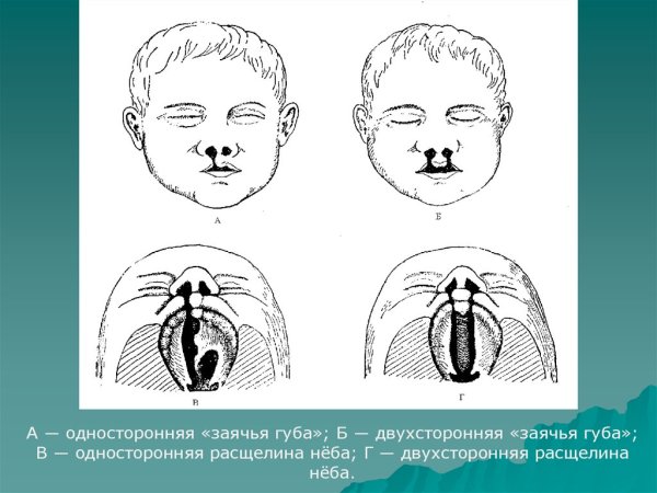 Заячья губа расщелина верхней губы