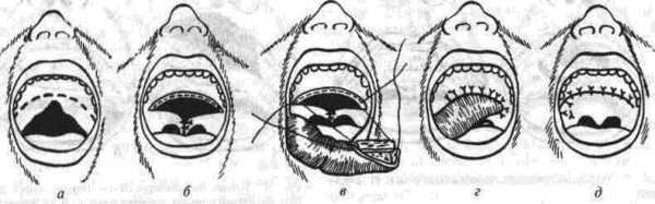 Патология Волчья пасть патология