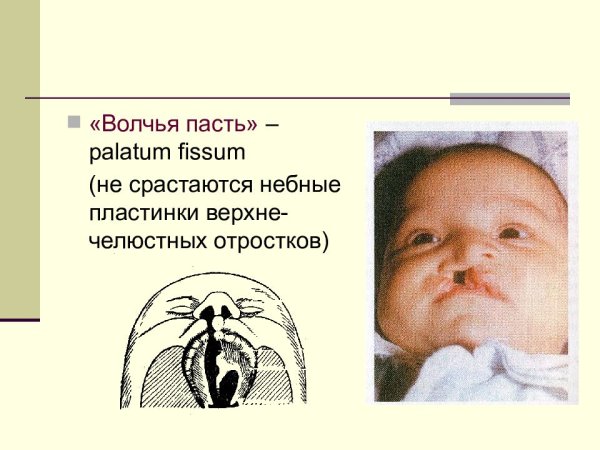 Врожденная расщелина верхней губы
