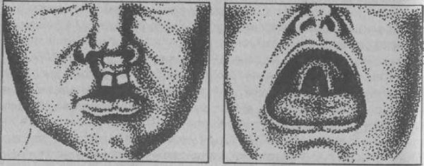 Волчья пасть уранопластика