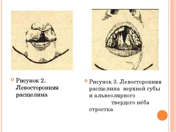 Врожденный порок, расщелина неба,