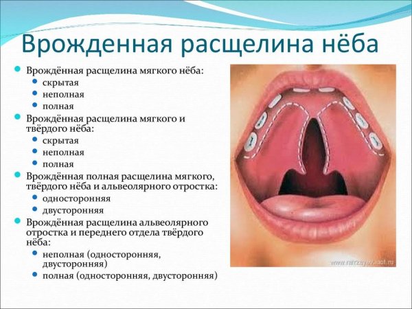 Врожденная расщелина неба