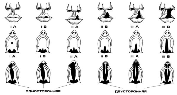 Расщелина Волчья пасть патология