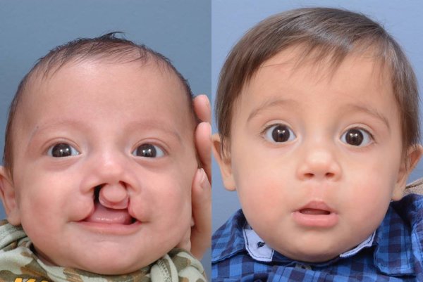 Хейлосхизис (заячья губа)