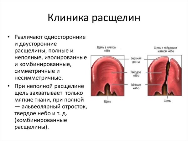 Врожденная расщелина альвеолярного отростка