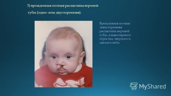 Расзелина верзней нуьы