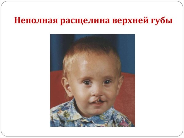 Расщелина твердого и мягкого неба