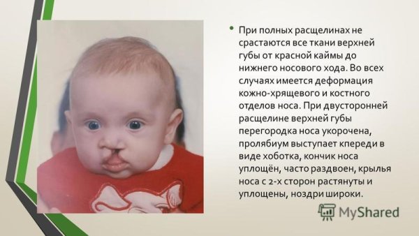 Расзелина верзней нуьы