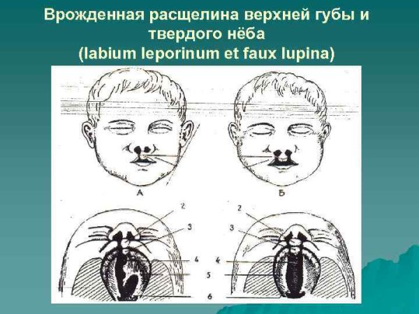 Врожденная субмукозная расщелина мягкого неба