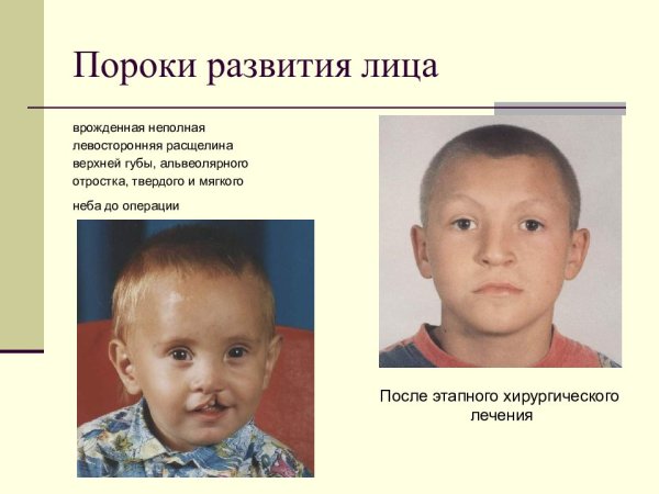 Аномалии развития ротовой полости