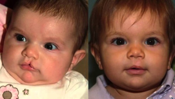 Косая расщелина лица колобома