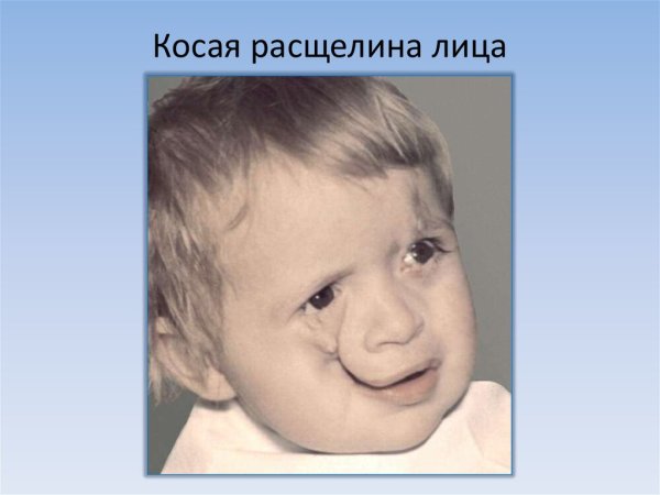 Ринолалия расщелина твёрдого неба