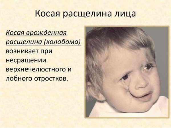 Заячья губа у новорожденного