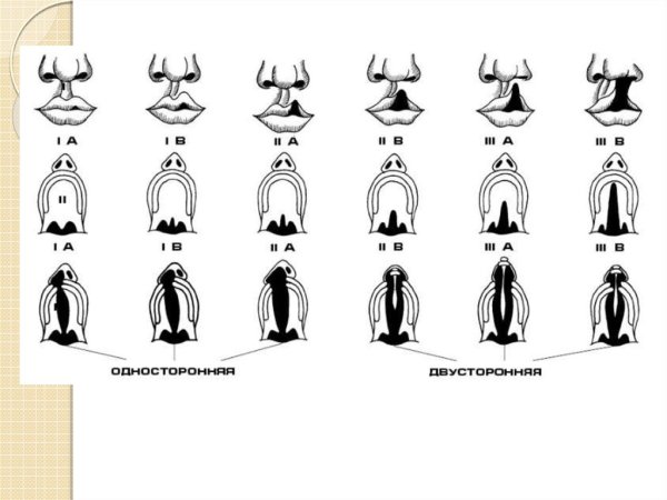 Двусторонняя расщелина губы