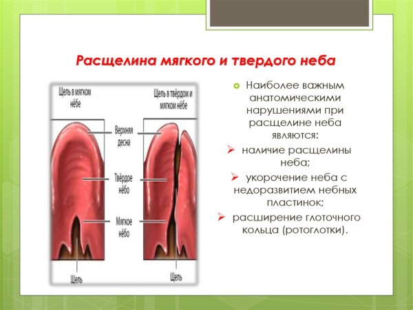 Врожденная расщелина твердого неба