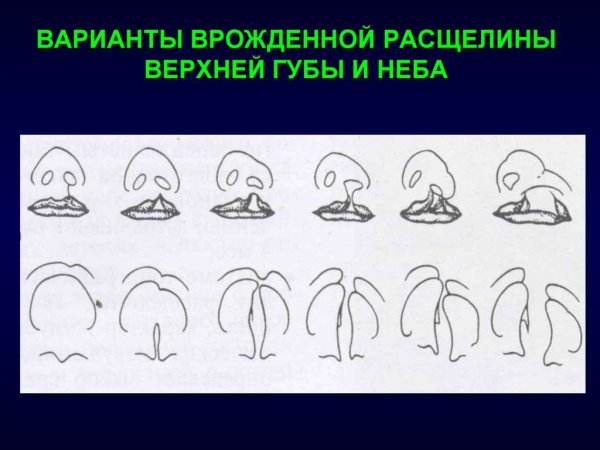 Уранопластика Оперативная хирургия