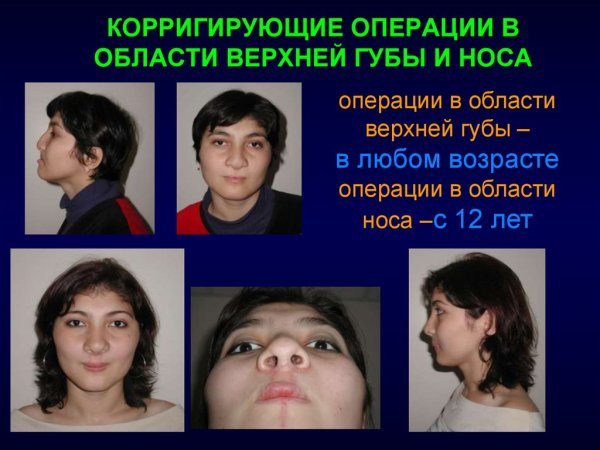 Неполная расщелина неба