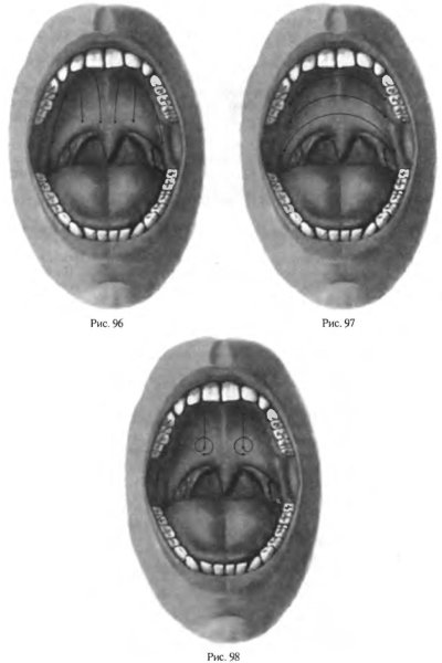 Логопедический массаж при ринолалии