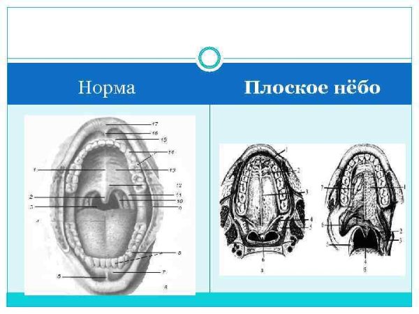 Волчья пасть расщелина твердого неба