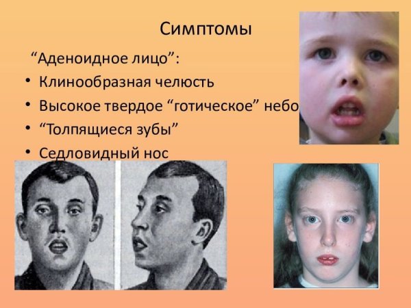 Форма свода твердого неба