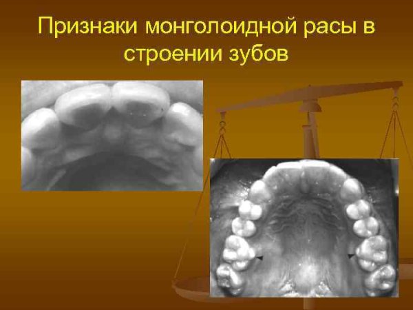 Расщелина твердого неба и альвеолярного отростка