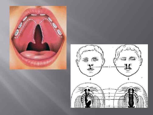 Аномалии строения артикуляционного аппарата