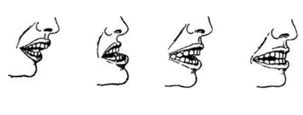 Рахит уплощение затылка