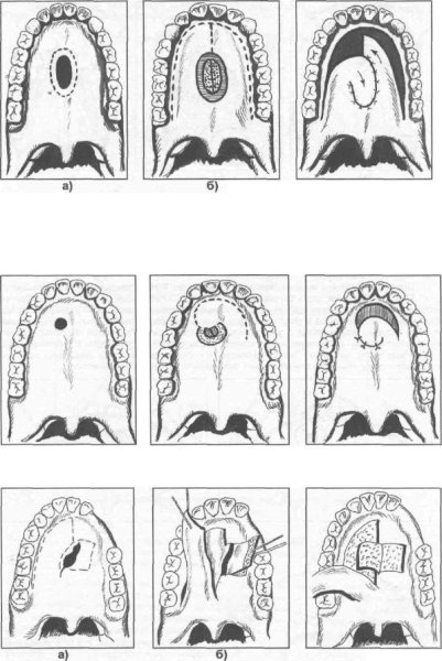 Анкилоз нижней челюсти