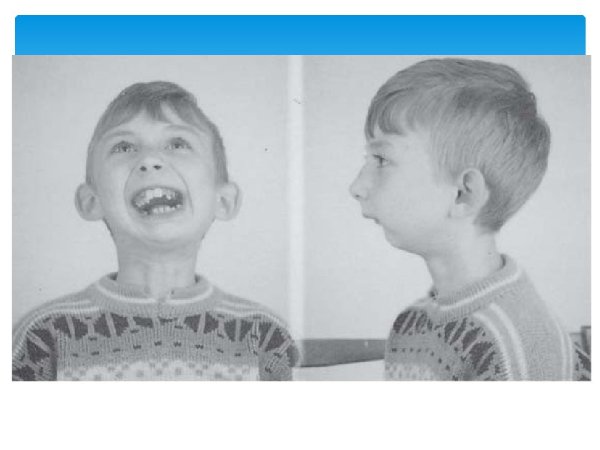 Поперечные небные складки