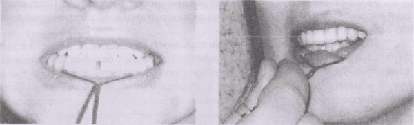 Уранопластика Лангенбека