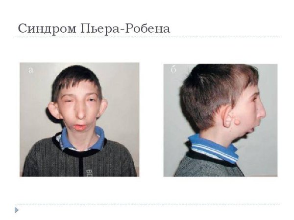 Врожденная расщелина твердого неба