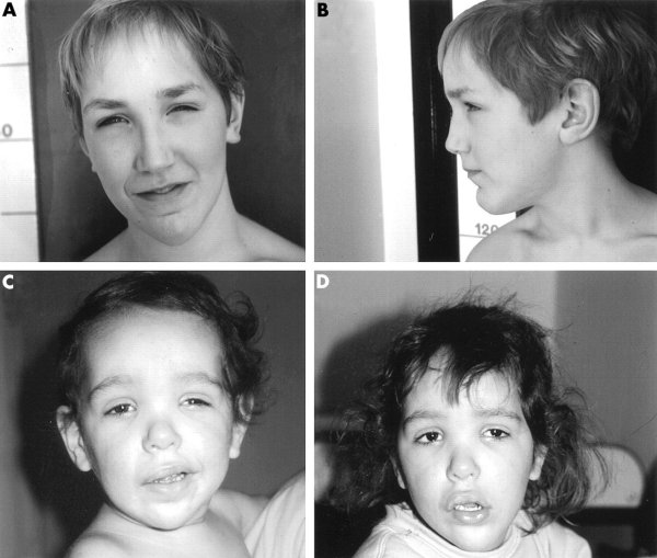 Аденоидитное лицо у ребенка