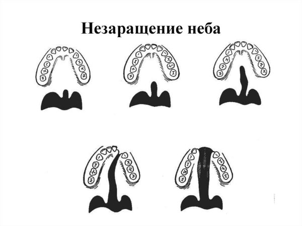 Расщелина твердого и мягкого неба