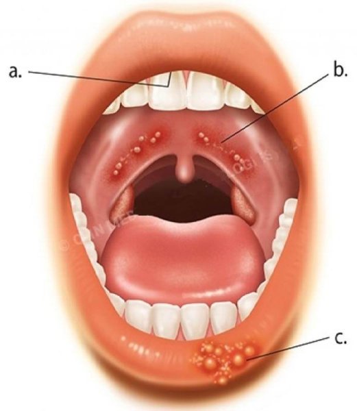 Инфекционный мононуклеоз ангина
