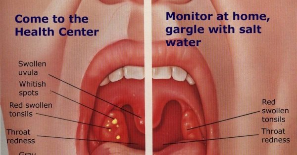 Миндалины острый тонзиллит
