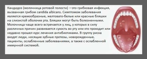 Стрептококковый тонзиллит зев